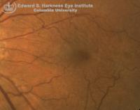 Macular Pucker